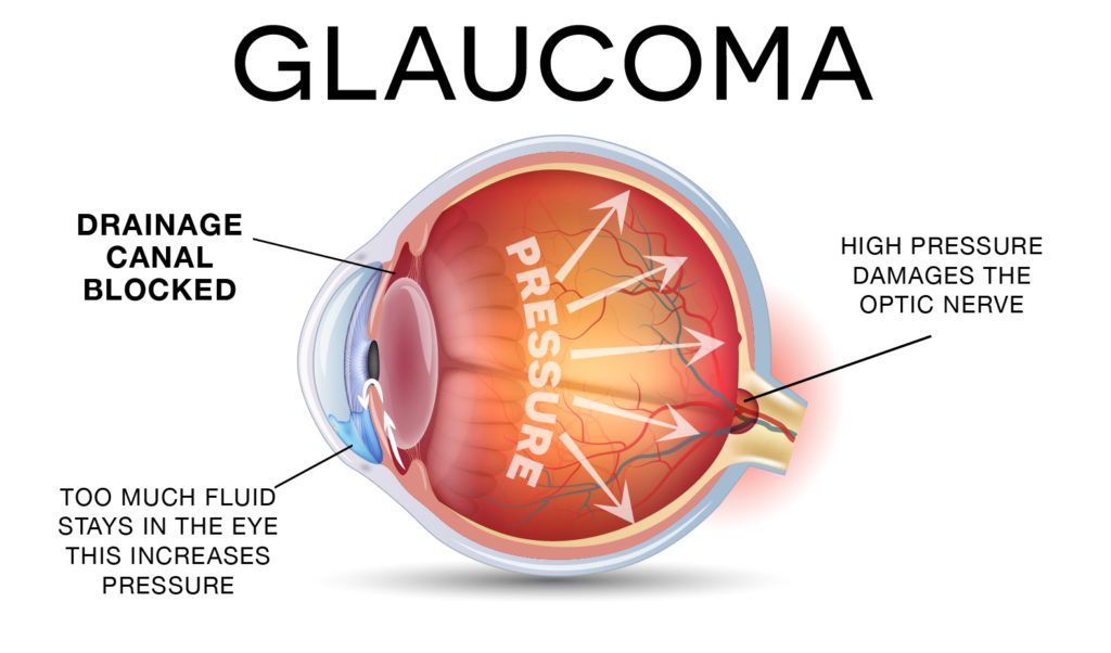 understanding-eye-pressure-glaucoma-specialists